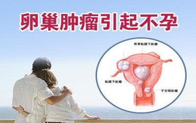 卵巢囊肿