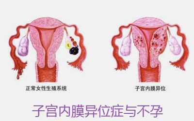 子宫内膜异位症检查